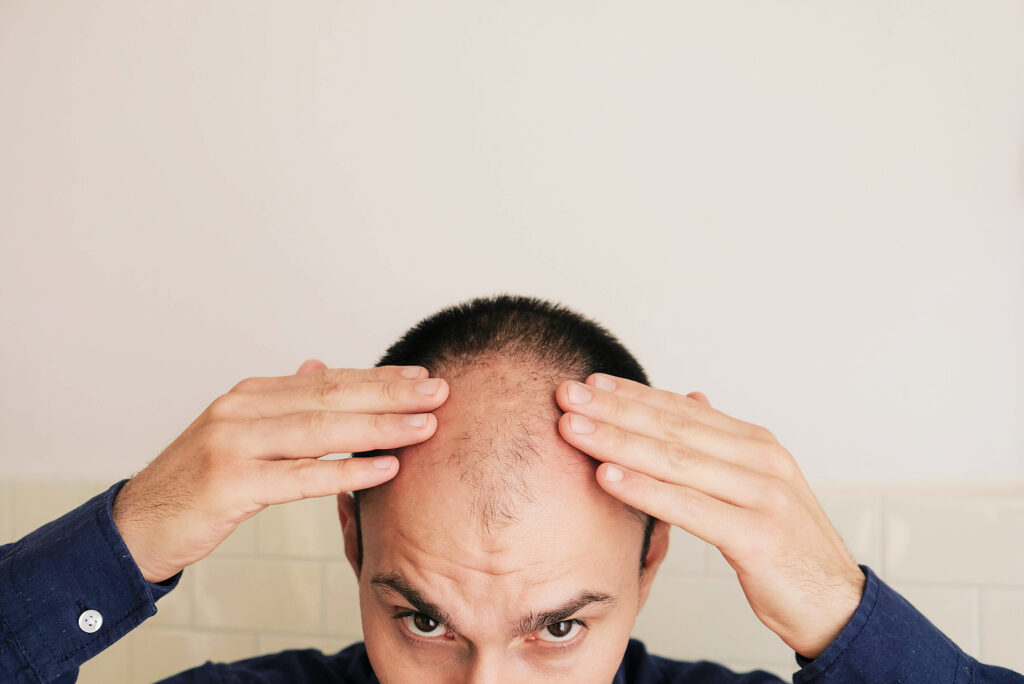 cheap finasteride - Baldness, alopecia in males